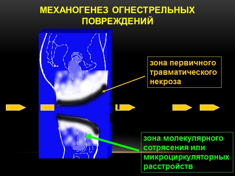 зона первичного  травматического  некроза зона молекулярного сотрясения или микроциркуляторных расстройств МЕХАНОГЕНЕЗ ОГНЕСТРЕЛЬНЫХ